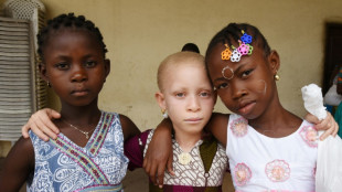 Albinism: lack of pigment plagued by deadly myths